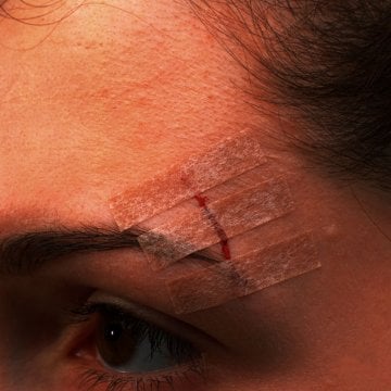 3M Wundverschlussstreifen Steri-Strip Blendtone