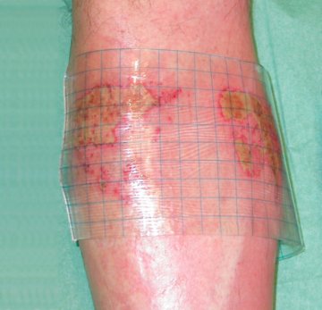 Hartmann HydroTac® transparent comfort