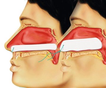 Raucocel Epistaxistamponade steril mit Faden (55 mm) (10 Stück)