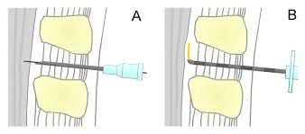 BD Yale Spinal-und Lumbalpunktionskanüle