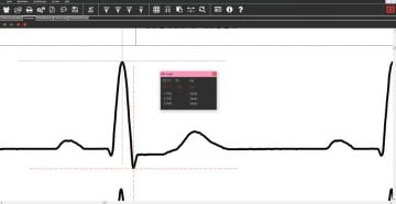 Dr. G. Schmidt EKG SmartScript PC-EKG-System